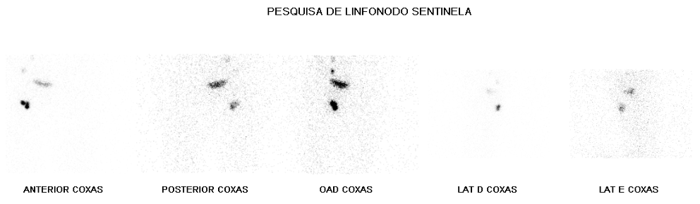 Linfonodo Sentinela Dimen Medicina Nuclear